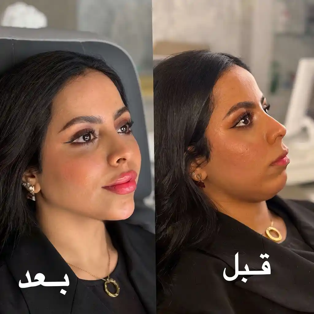 حقن الفيلر