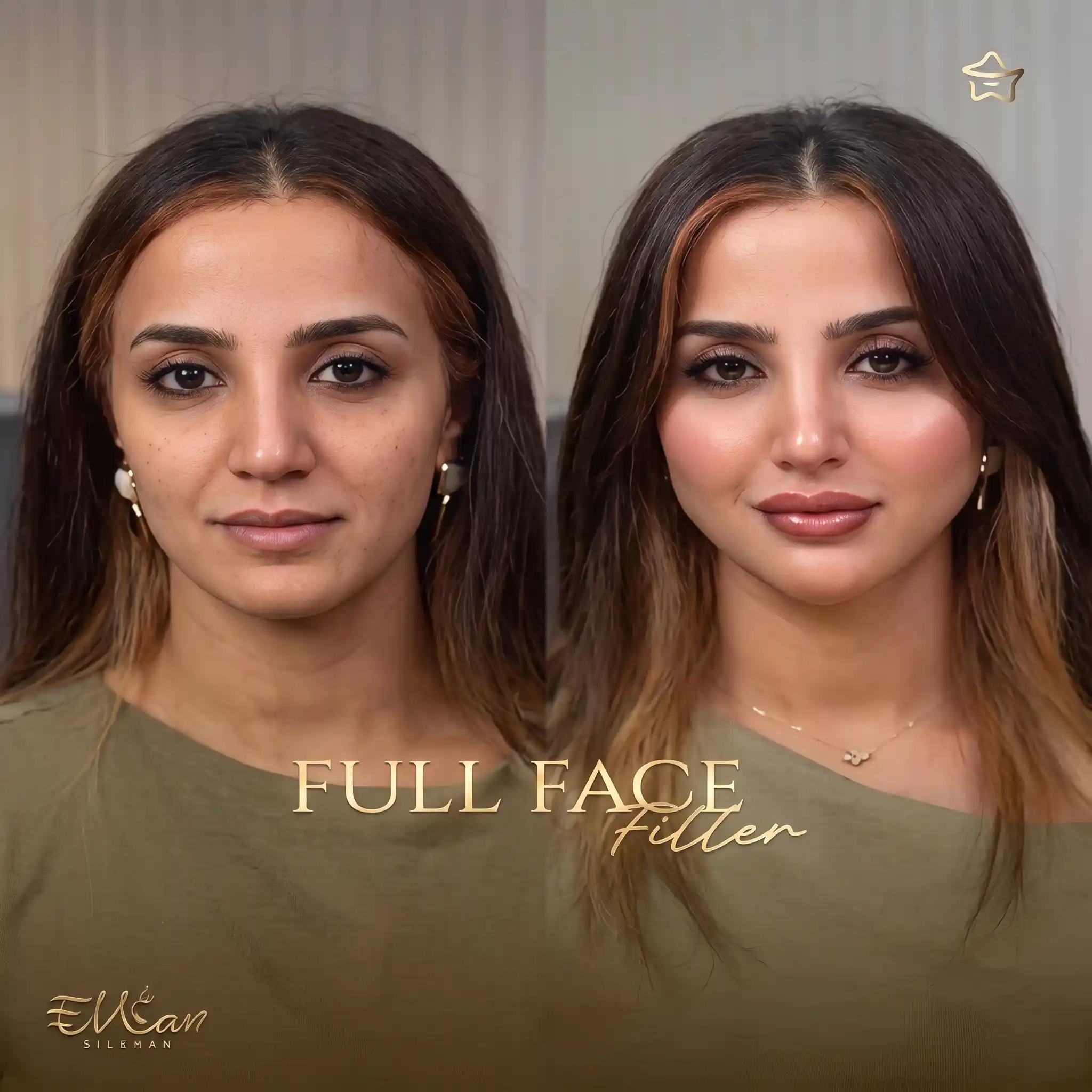 استدارة الوجه بالفيلر